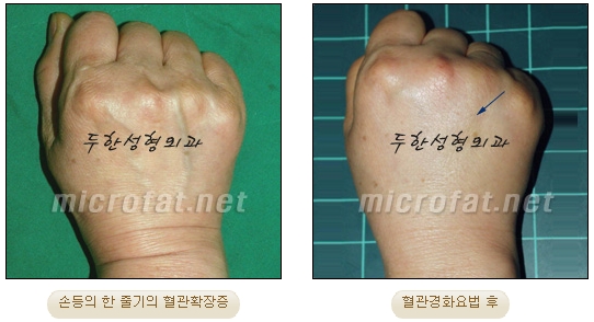 [Duhan Plastic Surgery Clinic Varicose Veins] - [Hand and Arm Venous Dilation] image 9