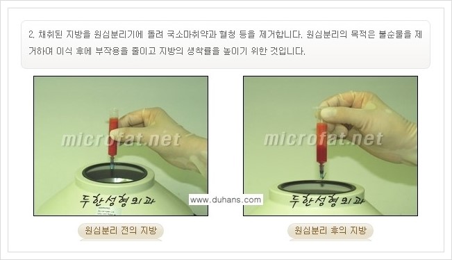 ⁠⁠[두한성형외과 경쟁력 미세지방이식] - [턱 미세지방이식 - 안면윤곽 교정 안내] 관련 이미지 8