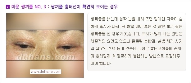 [두한성형외과 경쟁력 쌍꺼풀 재수술, 극한 눈재수술] - [자연스러운 눈매로의 복원 쌍꺼풀 재수술 대상 안내] 관련 이미지 4