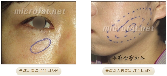 얼굴지방이식 두한성형외과 - 볼지방이식 관련 이미지 46