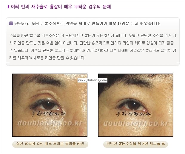 [두한성형외과 경쟁력 쌍꺼풀 재수술, 극한 재수술] - [쌍꺼풀 재수술, 극한 재수술 시 문제점 안내] 관련 이미지 3