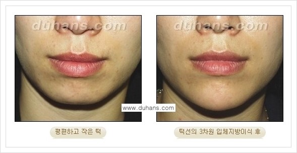 [두한성형외과 경쟁력 미세지방이식] - [아름다운 얼굴선 - 무턱, 오목턱, 비대칭턱 지방이식 안내] 관련 이미지 4
