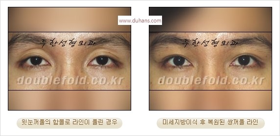 [두한성형외과 경쟁력 쌍꺼풀 재수술] - [쌍꺼풀 재수술 과정] 관련 이미지 104