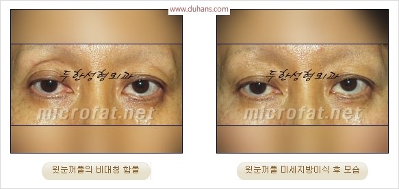 [두한성형외과 경쟁력 눈성형 리더] - [윗눈꺼풀 함몰( #꺼진눈꺼풀) 미세지방이식과 상안검성형]#꺼진눈성형 , #눈위함몰 관련 이미지 15