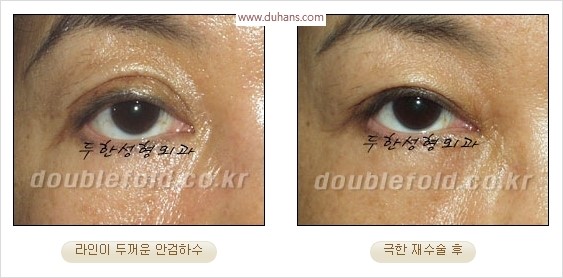 [두한성형외과 경쟁력 눈성형] - [극한 재수술, 함몰된 눈꺼풀 라인교정, 안검하수(졸리운 눈매)] 관련 이미지 10