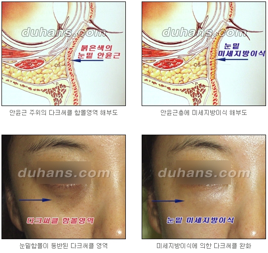 두한성형외과 눈밑성형 - 눈밑지방제거, 눈밑주름, 눈밑지방재배치 관련 이미지 60