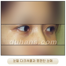 [두한성형외과 얼굴자가지방이식] - [눈밑 애교살 시술을 위한 미세지방이식] 관련 이미지 2