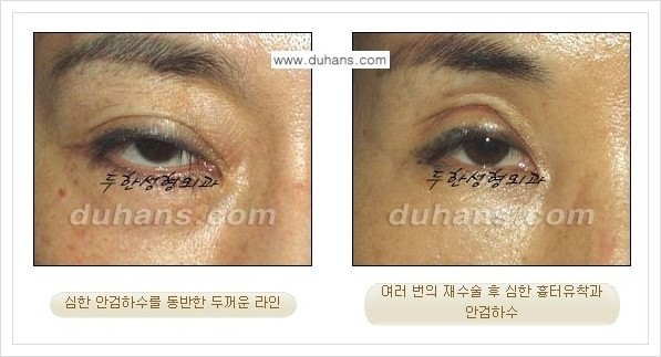 [두한성형외과 경쟁력 극한 재수술, 쌍꺼풀 재수술] - [쌍꺼풀 재수술이 어렵거나 불가능한 경우의 안내] 관련 이미지 2