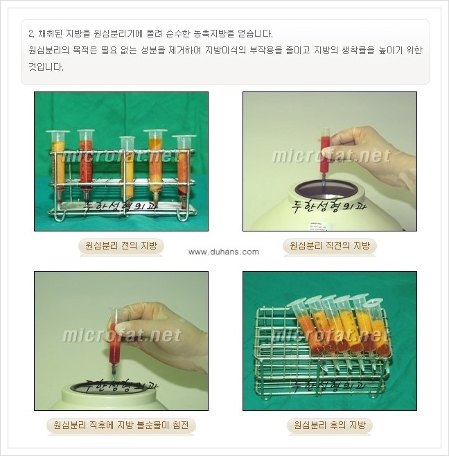 [두한성형외과 경쟁력 미세지방이식] - [타병원에서의 미세지방이식 부작용 교정 방법 안내] 관련 이미지 8