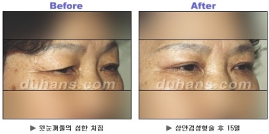 Blepharoplasty, Duhan Plastic Surgery - Upper and Lower Eyelids image 12