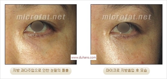 [두한성형외과 경쟁력 미세지방이식] - [지방이식 부작용 교정 모습 안내] 관련 이미지 24