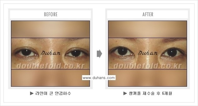 [두한성형외과 경쟁력 쌍꺼풀(눈) 재수술] - [쌍꺼풀 재수술시 잘못된 수술로 인한 넓어진 흉터 처리 안내] 관련 이미지 5