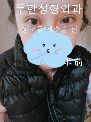[두한성형외과 쌍커풀재수술] - [쌍수흉터] 관련 이미지 3