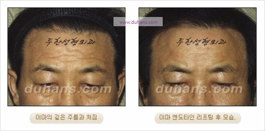 [두한성형외과 주름성형] - [주름교정술 - 강력한 리프팅 파워 엔도타인 리프팅 ] 관련 이미지 27