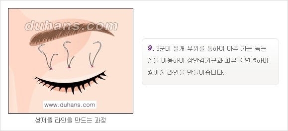 [두한성형외과 경쟁력 눈성형]- [최소 부기로 일상의로의 복귀가 가능한 아름다운 퀵쌍꺼풀(부분절개법) 수술] 관련 이미지 9
