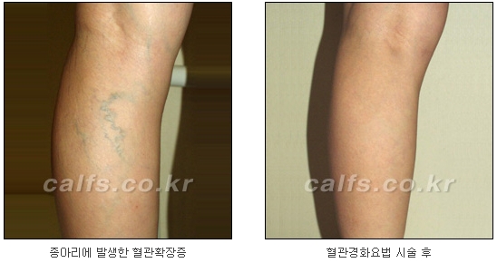 ​[두한성형외과 종아리성형] - [나에게 맞는 종아리시술] 관련 이미지 30