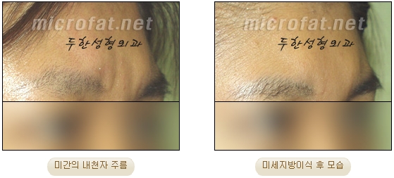 [두한성형외과 자가지방이식] - [미간주름] 관련 이미지 19