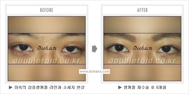 [두한성형외과 경쟁력 쌍꺼풀 재수술, 극한 눈재수술] - [두툼한 소세지 쌍꺼풀 라인 교정] 관련 이미지 9