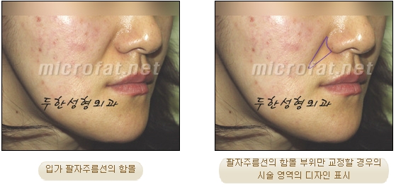 [두한성형외과 지방이식] - [귀족수술과 인디언밴드 교정] 관련 이미지 5