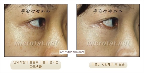 [두한성형외과 경쟁력 눈밑성형] - [과도한 눈밑지방제거의 부작용 후 눈밑지방재배치] 관련 이미지 13