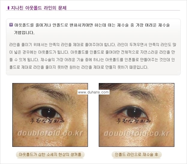 [두한성형외과 경쟁력 있는 쌍꺼풀 재수술] - [극복해야 할 극한의 상황과 문제들] 관련 이미지 6