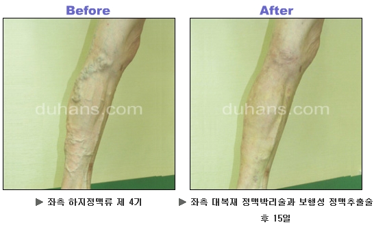 [두한성형외과 정맥류] - [하지정맥류, 정맥확장증, 혈관확장증] 관련 이미지 29