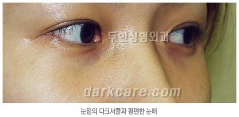 [Duhan Plastic Surgery Eye Area Surgery] - [Dark Circles and Aegyo-sal] image 5