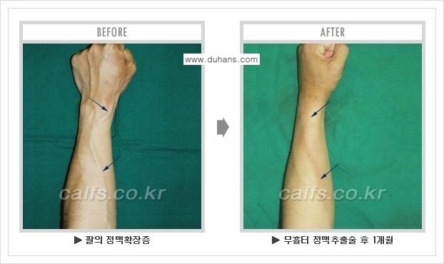 [두한성형외과 정맥류 치료] - [손, 팔 정맥확장증 사진자료 안내 ①] 관련 이미지 6