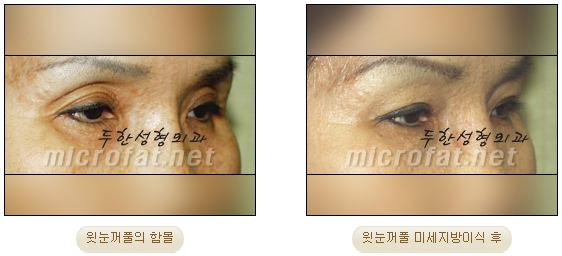 [두한성형외과 자가지방이식] - [미세지방이식 안내] 관련 이미지 11