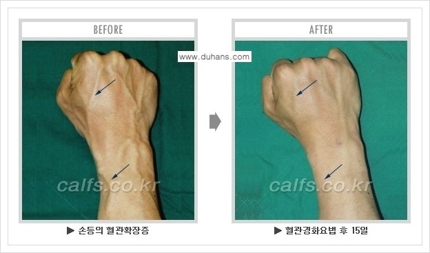 ⁠⁠[두한성형외과 정맥류 치료] - [손, 팔 정맥확장증 사진자료 안내 ②] 관련 이미지 9