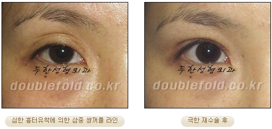 [DoubleFold Plastic Surgery Eye Surgery] - [Revision Surgery for Thick Double Eyelids] image 33