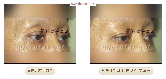 [두한성형외과 경쟁력 눈성형 리더] - [윗눈꺼풀 함몰( #꺼진눈꺼풀) 미세지방이식과 상안검성형]#꺼진눈성형 , #눈위함몰 관련 이미지 17