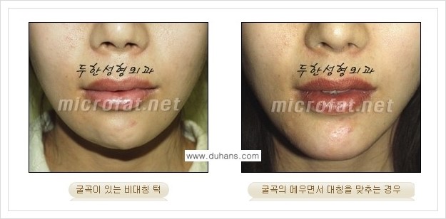 [두한성형외과 경쟁력 미세지방이식] - [얼굴 윤곽 무턱교정 안내 ①] 관련 이미지 6