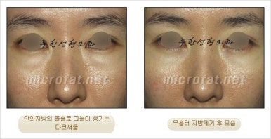 두한성형외과 눈밑수술 - 다크서클 수술 전후 관리 안내 관련 이미지 61