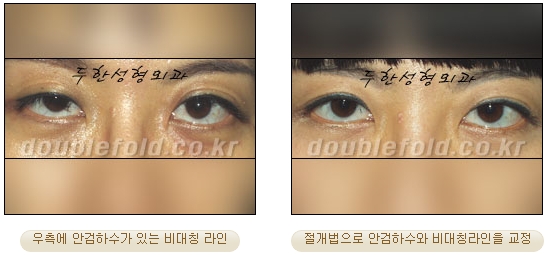[Duhan Plastic Surgery Secondary Double Eyelid Surgery] - [Sleepy Eye Appearance, Asymmetrical Eye Appearance, Ptosis] image 17