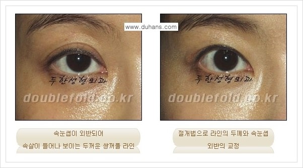 [두한성형외과 경쟁력 쌍꺼풀 재수술, 극한 재수술] - [속눈썹 외반 수술 방법 안내] 관련 이미지 4