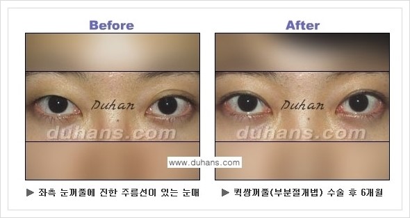 [두한성형외과 경쟁력 쌍꺼풀 재수술, 극한 재수술] - [퀵쌍꺼풀 안내] 관련 이미지 8