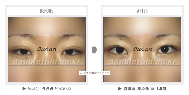 [두한성형외과 경쟁력 눈성형] - [쌍꺼풀 재수술 과정과 쌍꺼풀 재수술 실패의 원인, 쌍꺼풀 재수술의 성공 요건] 관련 이미지 9