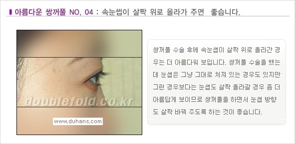 [두한성형외과 경쟁력 쌍꺼풀 재수술, 극한 재수술] - [일반적인 기준의 미운 쌍꺼풀과 아름다운 쌍꺼풀 안내] 관련 이미지 17