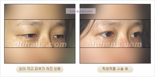 [두한성형외과 경쟁력 눈성형] - [자연스럽고 아름다운 눈매를 만드는 여러 가지 눈성형 방법] 관련 이미지 14