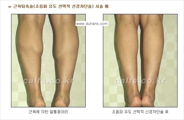 [두한성형외과 경쟁력 있는 종아리성형] - [종아리 축소 관련 흔한 질문과 답변들 1.] 관련 이미지 5