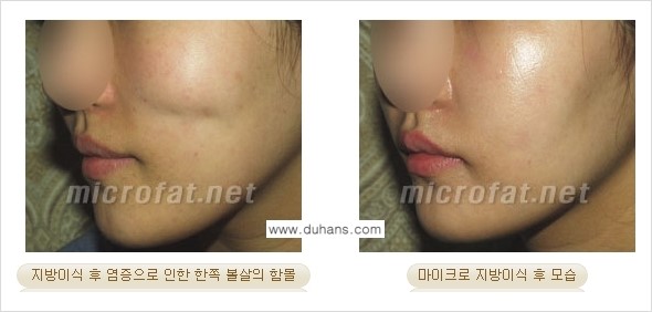 [두한성형외과 경쟁력 미세지방이식] - [지방이식 부작용 - 지방이식 후 발생한 굴곡현상에 대한 안내] 관련 이미지 3