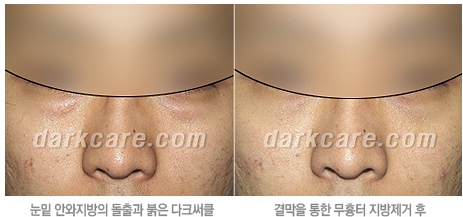 [두한성형외과 눈밑성형] - [무흉터 눈밑지방제거] 관련 이미지 7