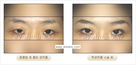 [두한성형외과 성형 FOCUS] - [퀵쌍꺼풀 수술 ②] 관련 이미지 5