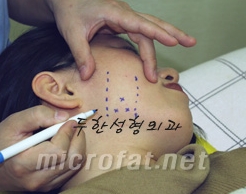 [두한성형외과 보톡스] - [사각턱 보톡스 시술 안내] 관련 이미지 6
