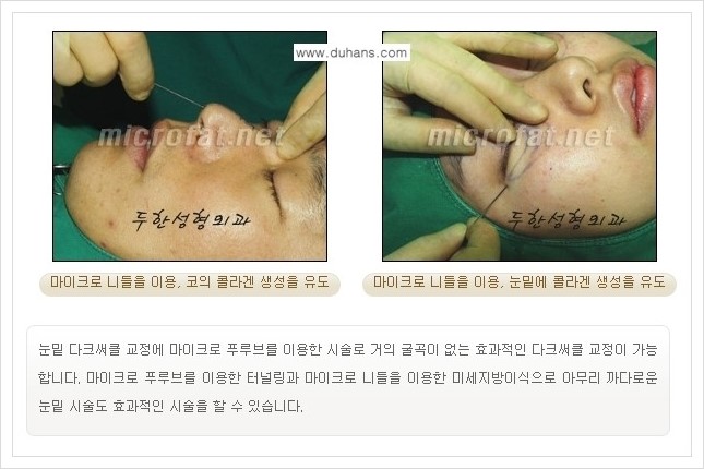 [두한성형외과 경쟁력 미세지방이식] - [상표등록 "Col-fat(콜펫) 지방이식"의 장점 안내] 관련 이미지 3