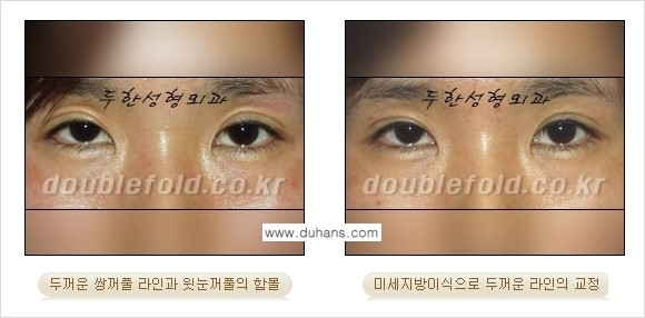 [두한성형외과 경쟁력 눈성형] - [미세지방이식으로 두꺼운 쌍꺼풀 라인의 교정 방법 안내] 관련 이미지 14
