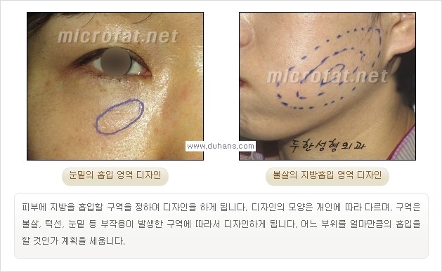 [두한성형외과 경쟁력 미세지방이식] - [타 병원에서 볼살 지방이식 이후 부작용 교정 방법 안내] 관련 이미지 16