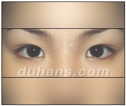 Candidates for Double Eyelid Revision Surgery: Unattractive Double Eyelids, Beautiful Double Eyelids image 40