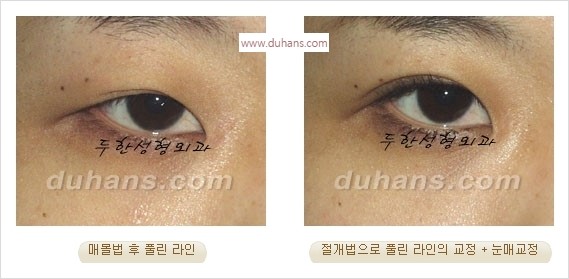 [두한성형외과 경쟁력 눈성형] - [풀려버린 쌍꺼풀 교정 방법] 관련 이미지 3